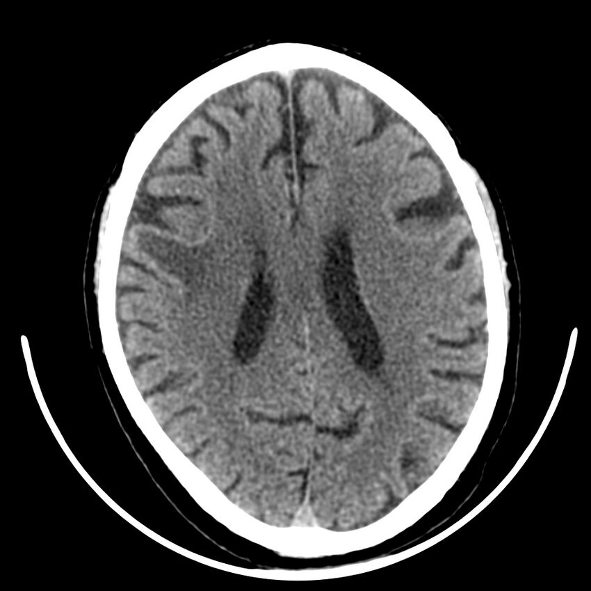 Brain metastasis (Radiopaedia 42617-45760 Axial non-contrast 30).jpg