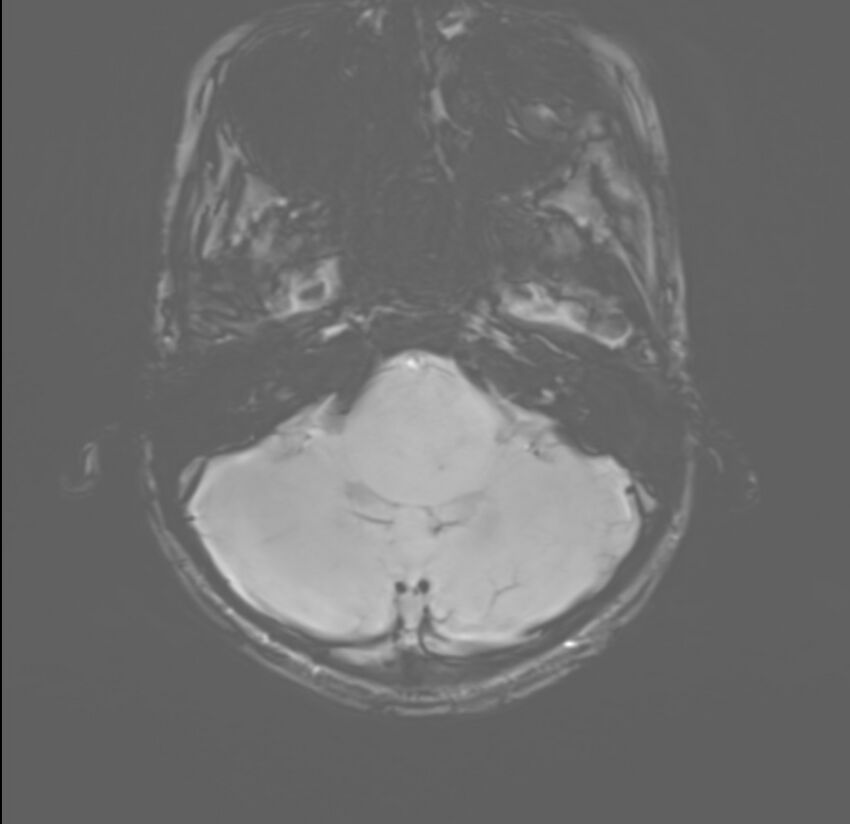 Brainstem glioma (Radiopaedia 70548-80674 Axial SWI 9).jpg