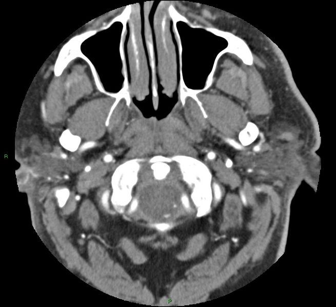 File:Brainstem hemorrhage (Radiopaedia 58794-66028 D 11).jpg