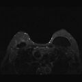 Breast implants - MRI (Radiopaedia 26864-27035 T2 SPAIR 38).jpg