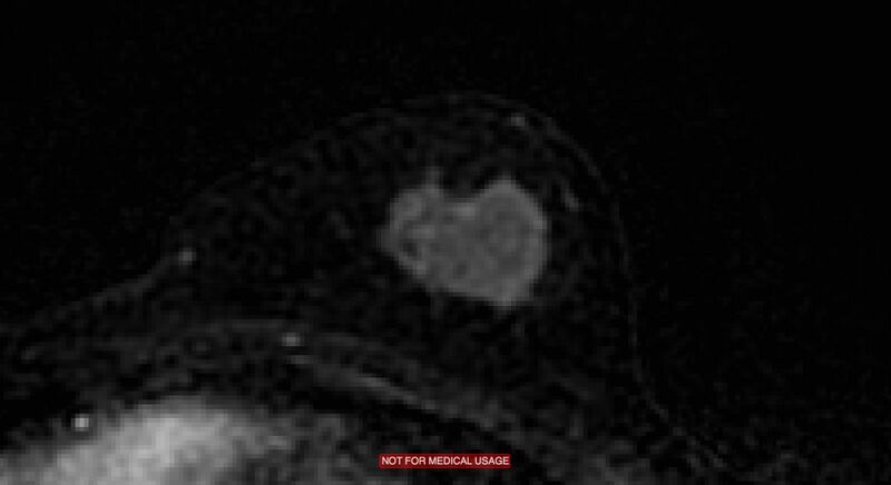File:Breast lymphoma (MRI) (Radiopaedia 34999-36498 C 15).jpg