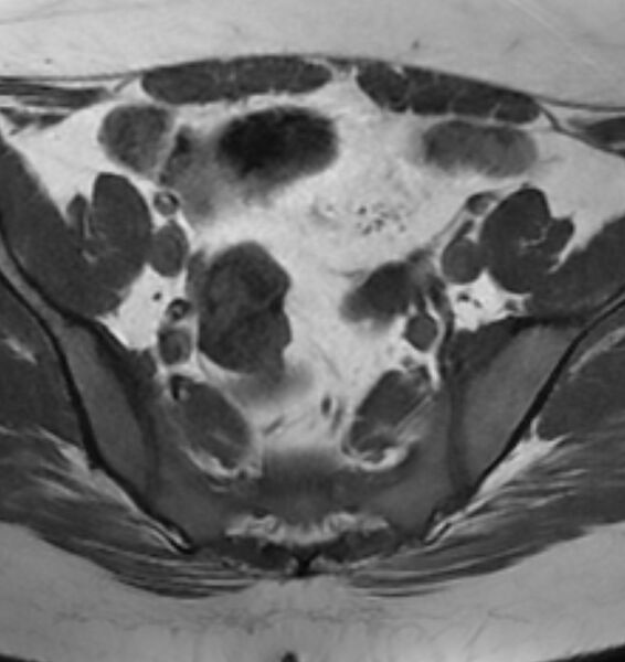 File:Broad ligament leiomyoma (Radiopaedia 81634-95516 Axial T1 7).jpg