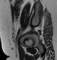 Broad ligament leiomyoma (Radiopaedia 81634-95516 Sagittal T2 27).jpg