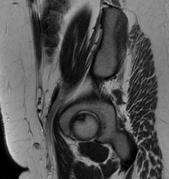 File:Broad ligament leiomyoma (Radiopaedia 81634-95516 Sagittal T2 27).jpg