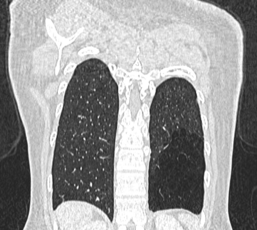Bronchial atresia (Radiopaedia 50007-55297 Coronal lung window 101).jpg