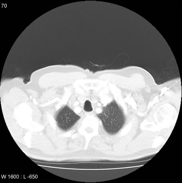 File:Bronchial carcinoid tumor with right lower lobe collapse (Radiopaedia 29060-29422 B 8).jpg