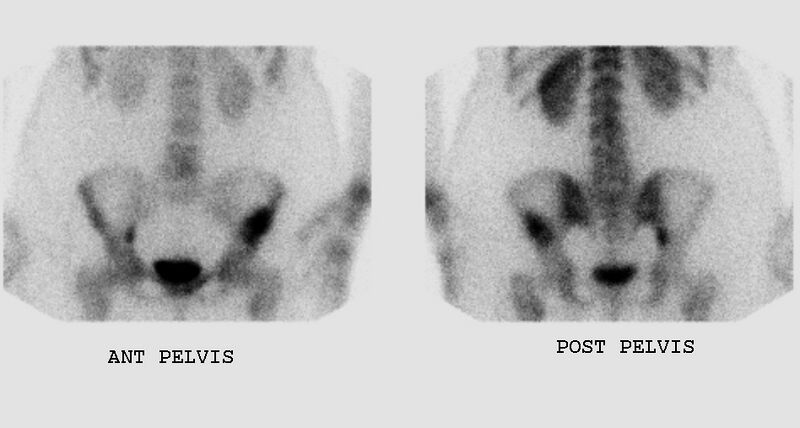 File:Bronchoalveolar carcinoma (Radiopaedia 13224-13234 A 3).jpg