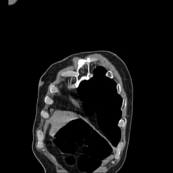 File:Bronchopleural fistula - postoperative complication (Radiopaedia 21020-20947 Coronal non-contrast 3).jpg