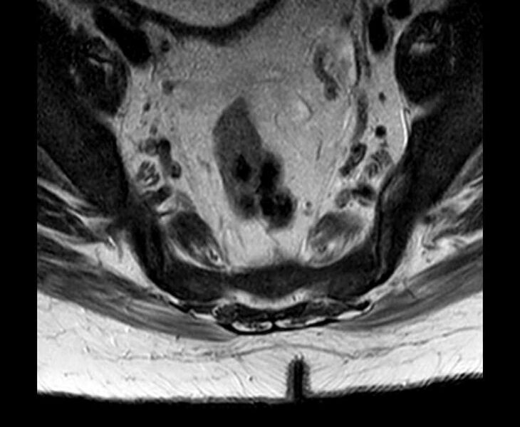 File:Brown tumors compressing the spinal cord (Radiopaedia 68442-78030 Axial T2 - lumbar 5).jpg