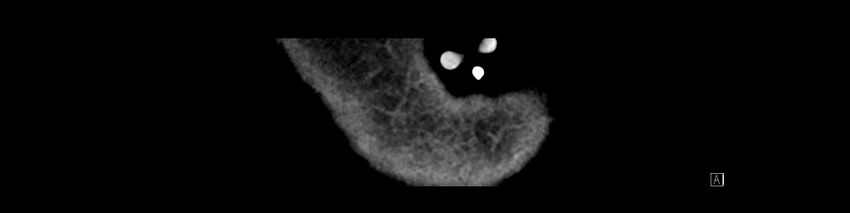 Buried bumper syndrome - gastrostomy tube (Radiopaedia 63843-72575 Coronal Inject 4).jpg