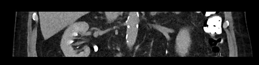 Buried bumper syndrome - gastrostomy tube (Radiopaedia 63843-72575 Coronal Inject 55).jpg