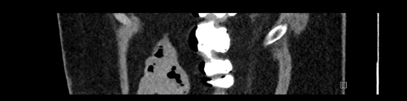 File:Buried bumper syndrome - gastrostomy tube (Radiopaedia 63843-72575 Sagittal Inject 15).jpg
