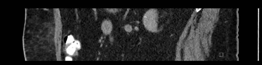 Buried bumper syndrome - gastrostomy tube (Radiopaedia 63843-72575 Sagittal Inject 44).jpg