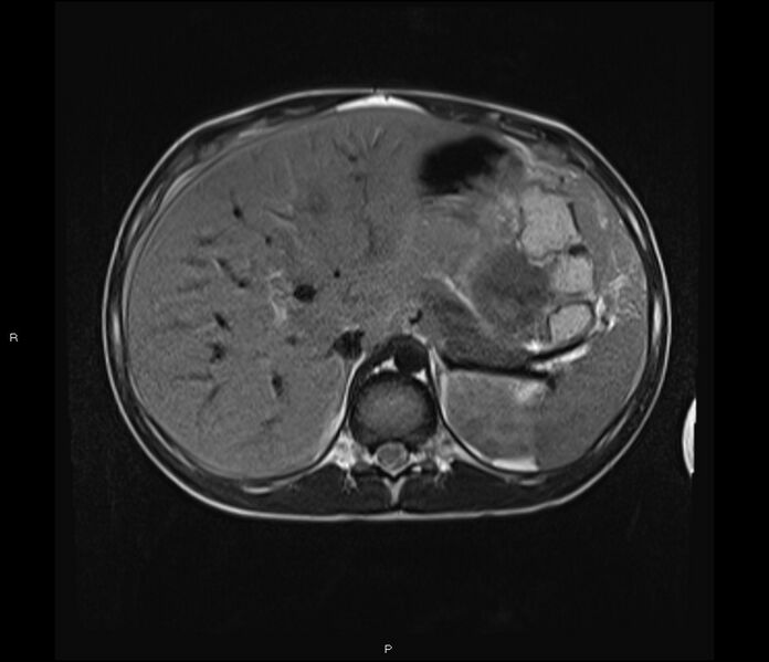 File:Burkitt lymphoma (bowel) (Radiopaedia 68839-78557 Axial T2 15).jpg
