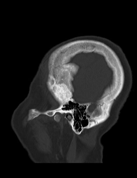 File:Burnt-out meningioma (Radiopaedia 51557-57337 Sagittal bone window 4).jpg