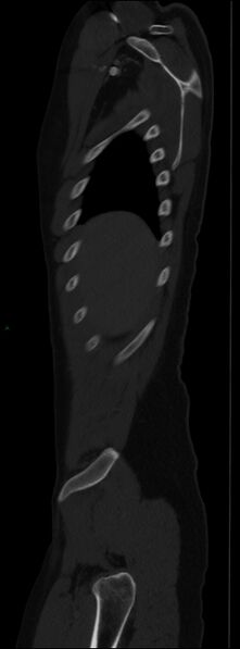 File:Burst fracture (Radiopaedia 83168-97542 Sagittal bone window 28).jpg
