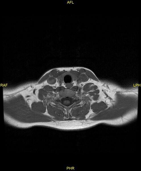 File:C5 nerve sheath tumor (Radiopaedia 85777-101596 Axial T1 21).jpg