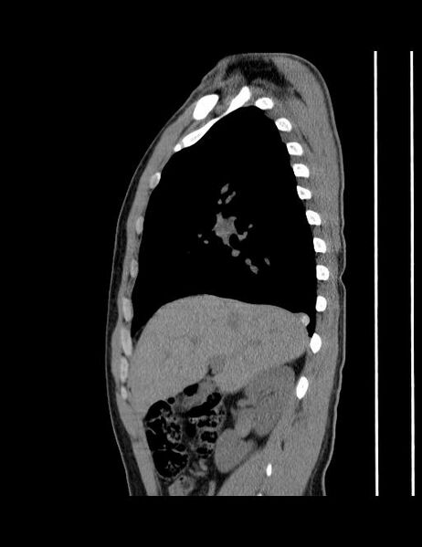 File:Calcifying pulmonary metastases (Radiopaedia 33359-34396 C 48).jpg