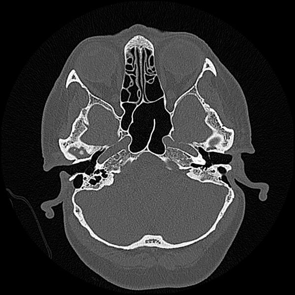 File:Canal up mastoidectomy (Radiopaedia 78108-90638 Axial bone window 58).jpg