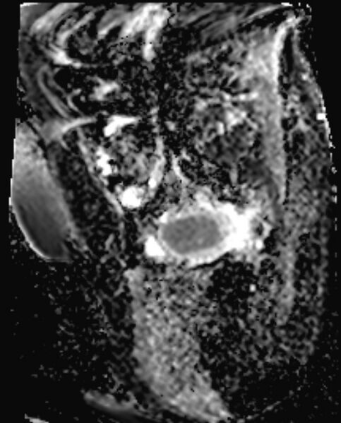 File:Cancer cervix - stage IIb (Radiopaedia 75411-86615 Sagittal ADC 18).jpg