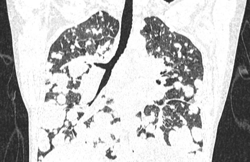 File:Cannonball metastases from breast cancer (Radiopaedia 91024-108569 Coronal lung window 79).jpg