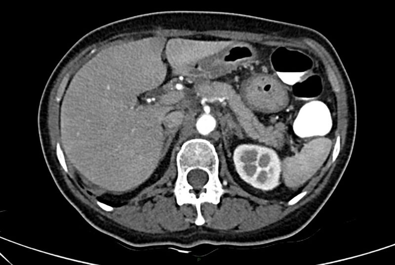 File:Carcinoid mesenteric tumor complicated by chylous ascites (Radiopaedia 76312-88926 A 20).jpg