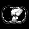 Cardiac fibroma (Radiopaedia 38974-41149 A 16).jpg