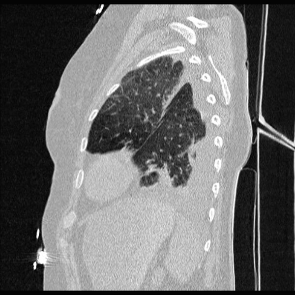 File:Cardiogenic pulmonary edema (Radiopaedia 29213-29609 Sagittal lung window 77).jpg