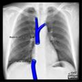 Cardiomediastinal anatomy on chest radiography (annotated images) (Radiopaedia 46331-50742 B 1).png