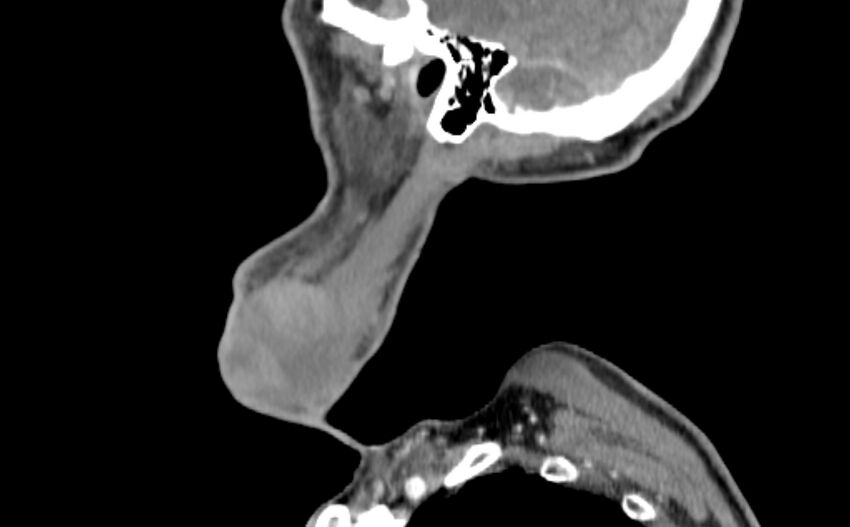 Carotid artery pseudoaneurysm (Radiopaedia 84030-99259 E 60).jpg