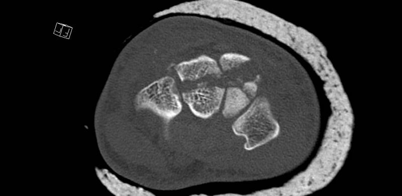 File:Carpal fractures (smart watch impaction) (Radiopaedia 55844-62430 Axial bone window 35).jpg