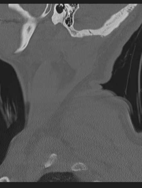 File:Cavernoma of cervical cord (Radiopaedia 50838-56346 Sagittal bone window 6).png
