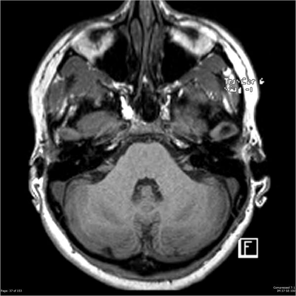File:Cavernous malformation (cavernous angioma or cavernoma) (Radiopaedia 36675-38237 Axial T1 26).jpg
