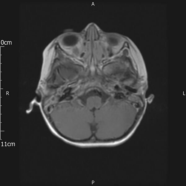 File:Cavernous sinus thrombosis (Radiopaedia 79414-92512 Axial T1 C+ 6).jpg