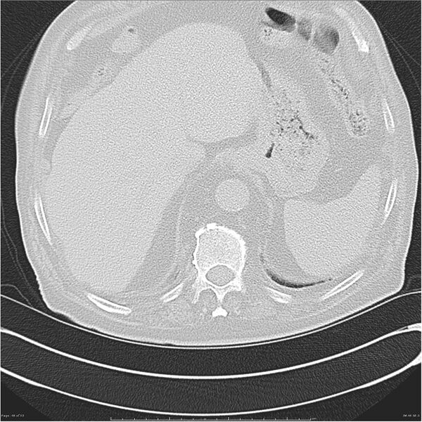 File:Cavitating left lower lobe lesion - squamous cell lung cancer (Radiopaedia 27749-28176 Axial lung window 46).jpg