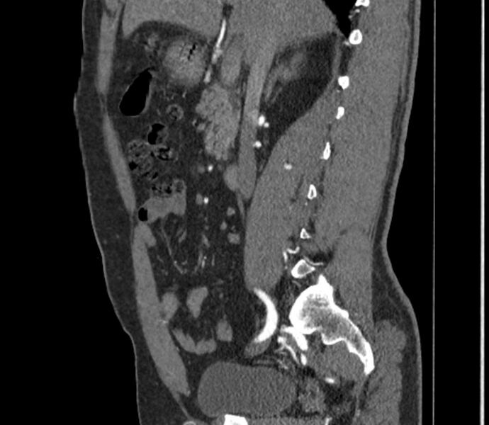 File:Celiac artery dissection (Radiopaedia 52194-58080 B 14).jpg