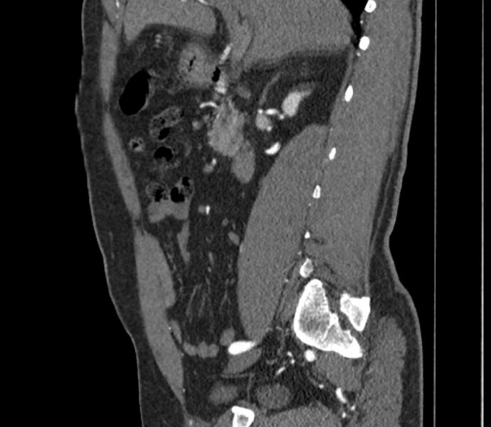 File:Celiac artery dissection (Radiopaedia 52194-58080 B 2).jpg