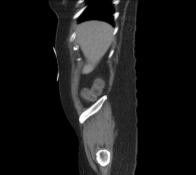 File:Celiac artery severe stenosis and dissection (Radiopaedia 44128-47842 A 33).jpg