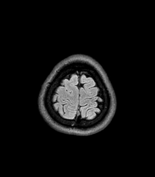 File:Central neurocytoma (Radiopaedia 79320-92380 Axial FLAIR 47).jpg