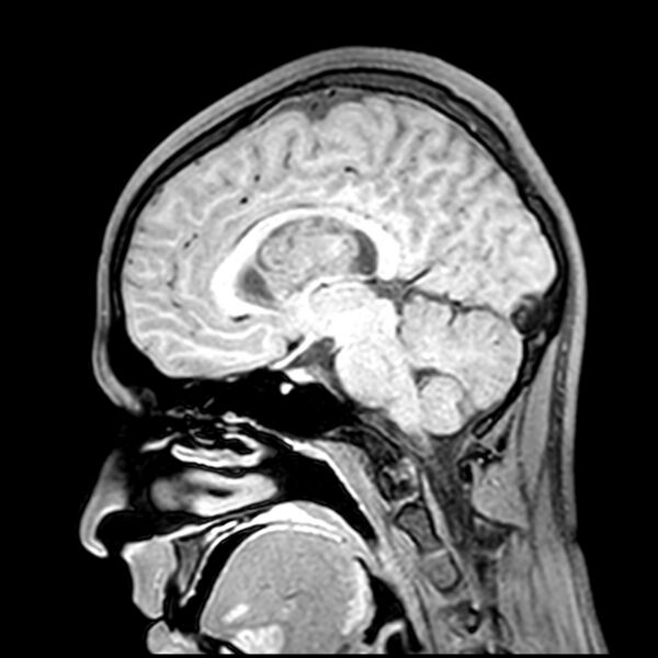 File:Central neurocytoma (Radiopaedia 79320-92380 Sagittal T1 122).jpg