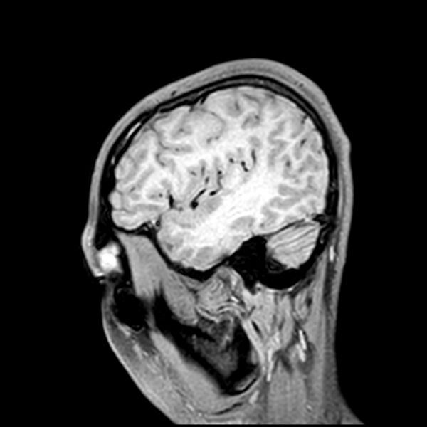 File:Central neurocytoma (Radiopaedia 79320-92380 Sagittal T1 58).jpg