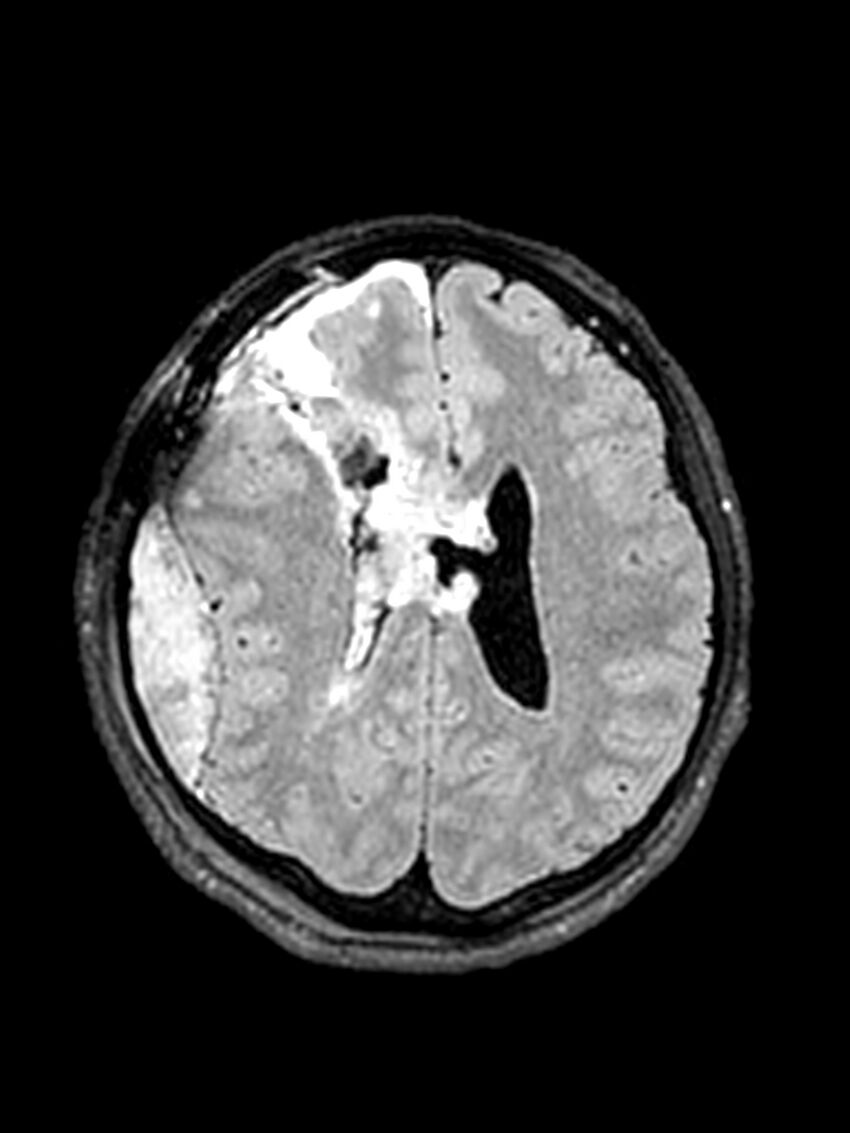 Central neurocytoma (Radiopaedia 79320-92381 Axial FLAIR 67).jpg