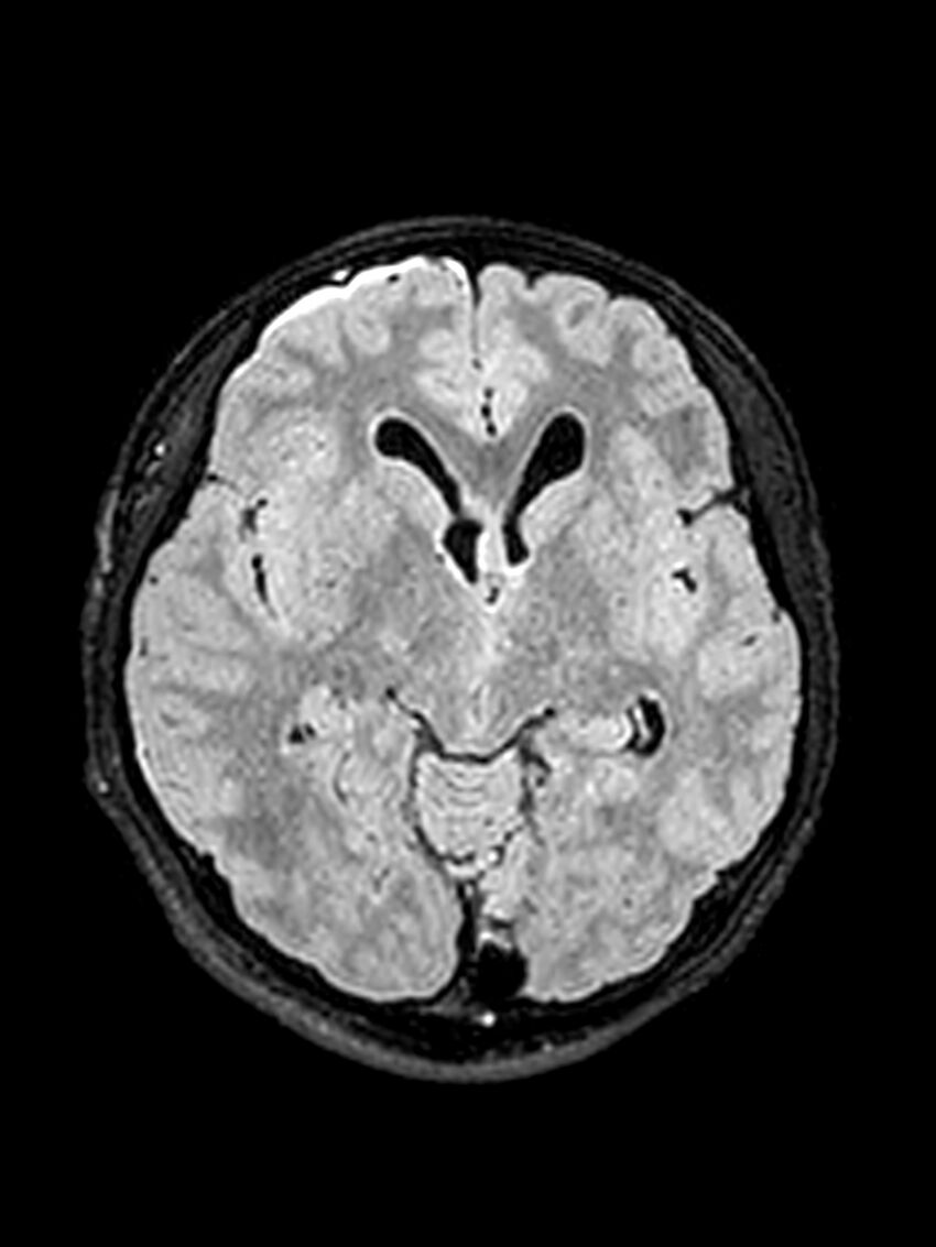 Central neurocytoma (Radiopaedia 79320-92381 Axial FLAIR 97).jpg
