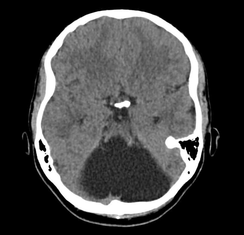 Cerebellar agenesis (Radiopaedia 30203-30817 Axial non-contrast 15).jpg