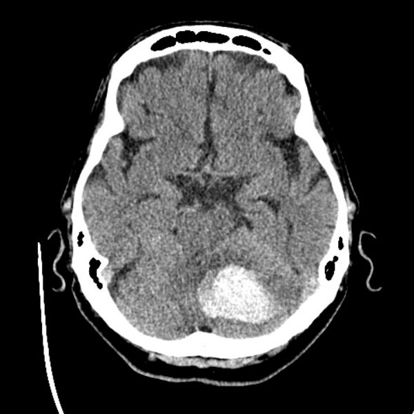 File:Cerebellar hemorrhage (Radiopaedia 27193-27359 Axial non-contrast 16).jpg