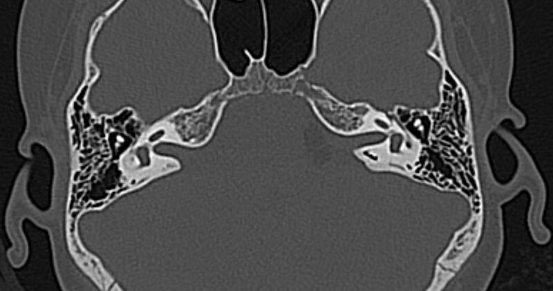 File:Cerebellopontine angle lipoma (Radiopaedia 57303-64242 Axial bone window 31).jpg