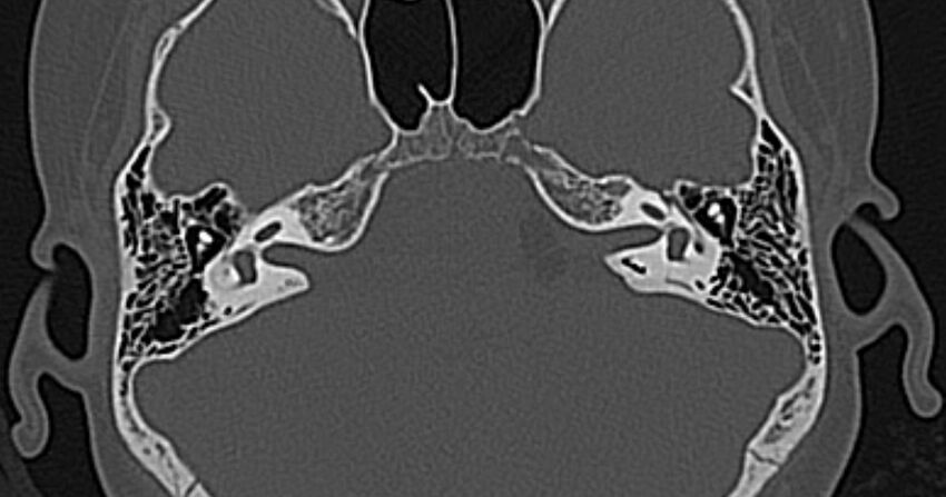 Cerebellopontine angle lipoma (Radiopaedia 57303-64242 Axial bone window 31).jpg