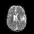 Cerebral abscess post cardiac surgery (Radiopaedia 27244-27420 Axial ADC 16).jpg