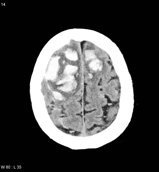 File:Cerebral abscesses secondary to contusions (Radiopaedia 5201-22213 Axial non-contrast 7).jpg