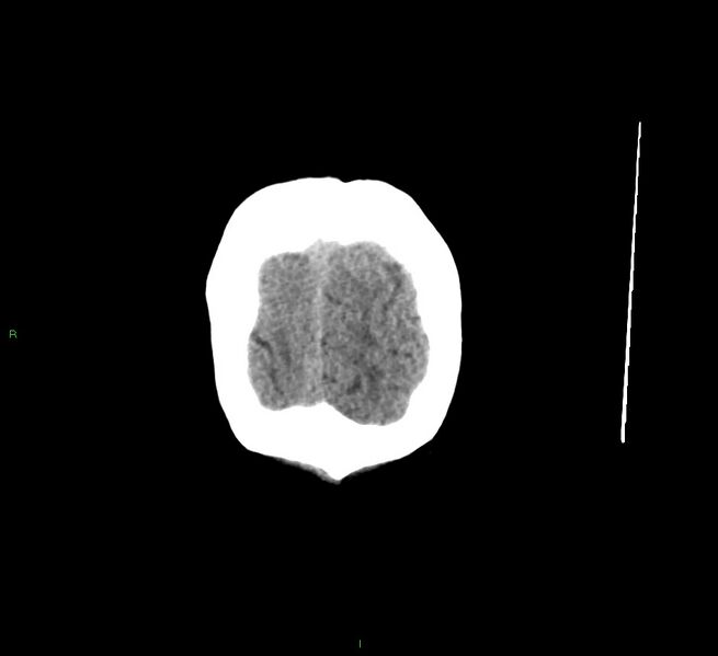 File:Cerebral amyloid angiopathy-associated lobar intracerebral hemorrhage (Radiopaedia 58529-65681 Coronal non-contrast 8).jpg